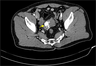 Dynamic FDG PET/CT on bladder paraganglioma: A case report